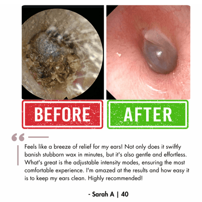 Earwax Remover