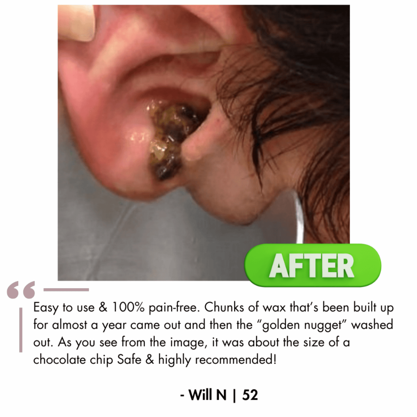 Earwax Remover