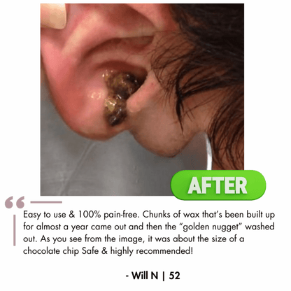 Earwax Remover